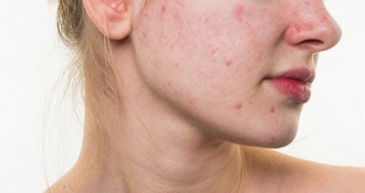 Nóng trong người nổi mẩn đỏ ảnh hưởng đến cuộc sống của bạn? xem ngay